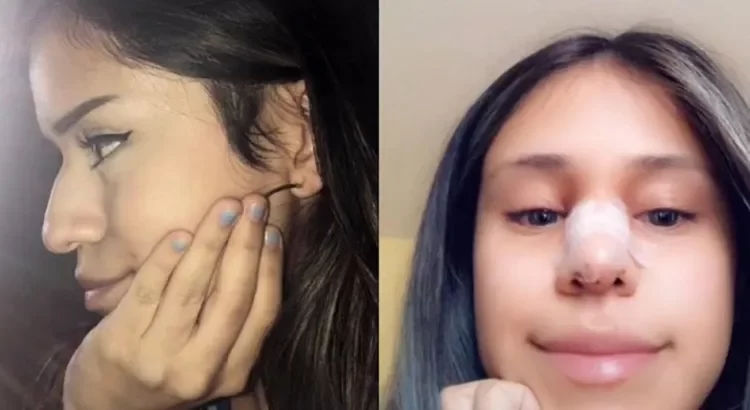 Obligó a su infiel novio a pagarle la rinoplastia